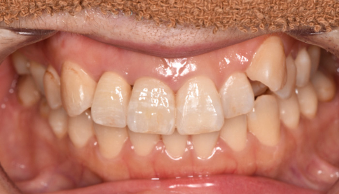 インプラント症例