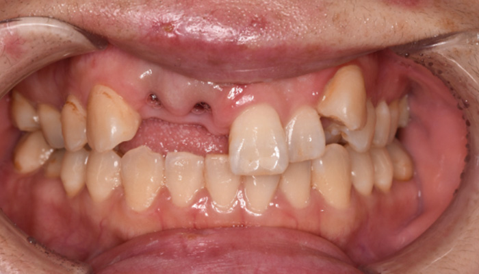 インプラント症例