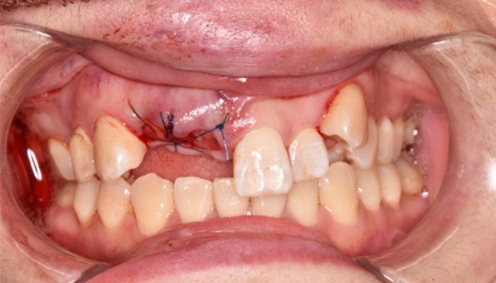 インプラント症例