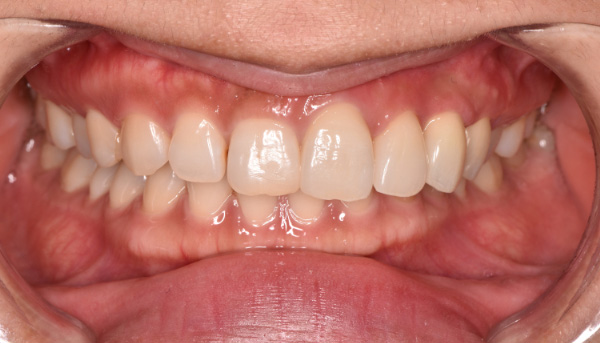 インプラント症例