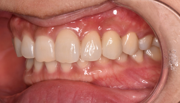 インプラント症例