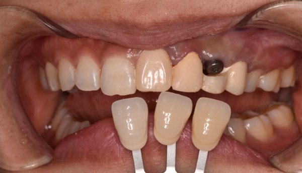 インプラント症例