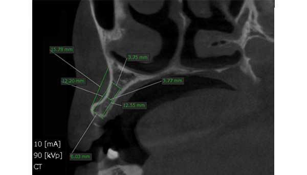 インプラント症例