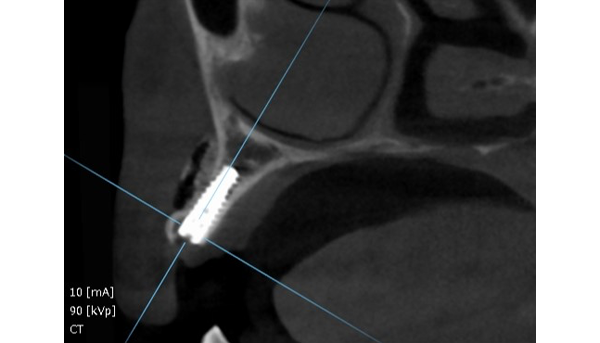 インプラント症例