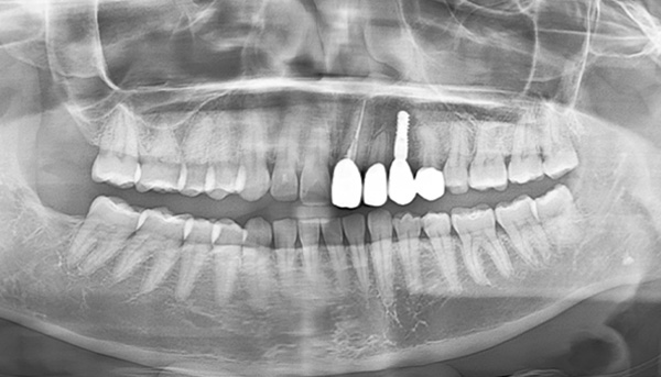 インプラント症例