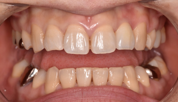 インプラント症例