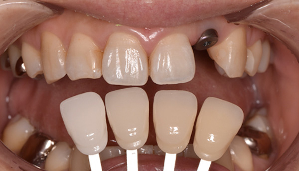 インプラント症例