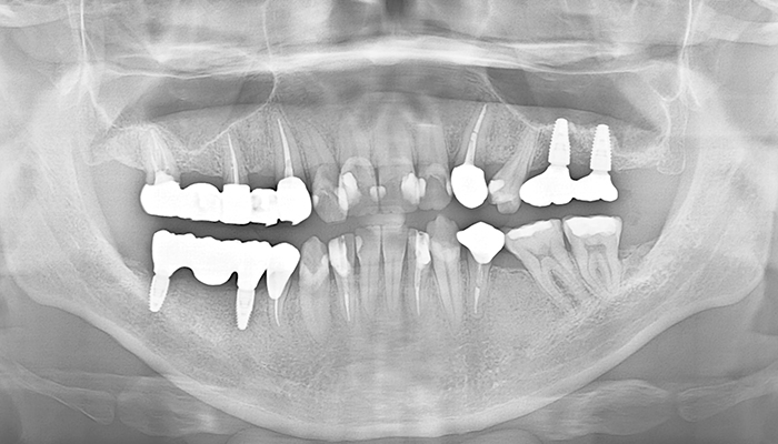 インプラント症例