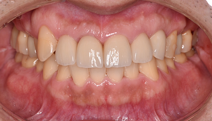 インプラント症例