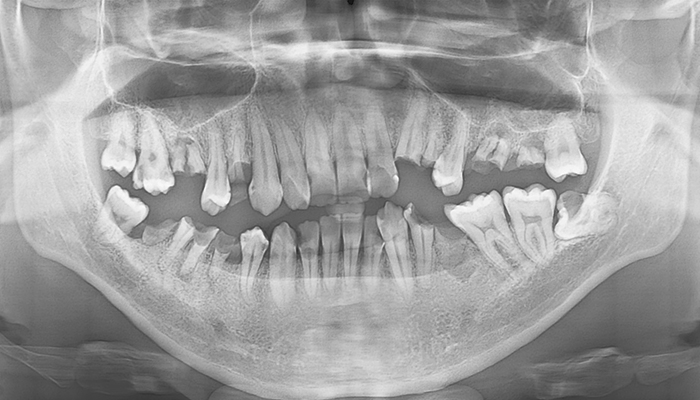 インプラント症例
