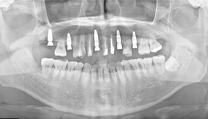 インプラント症例